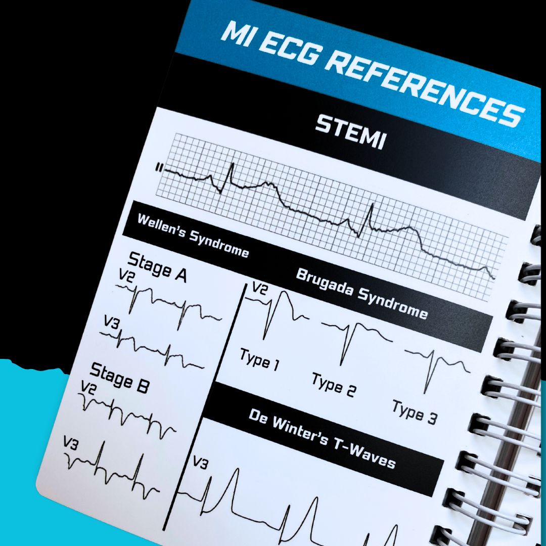 OMI ECG Interpretation