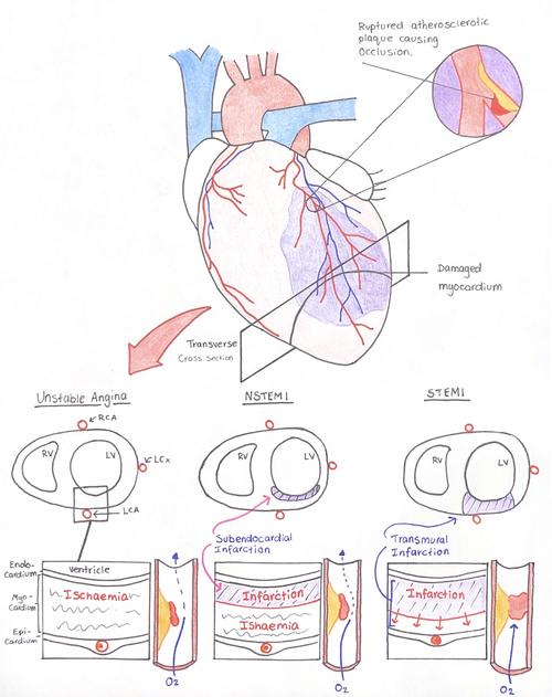 Acute Myocardial Infarction