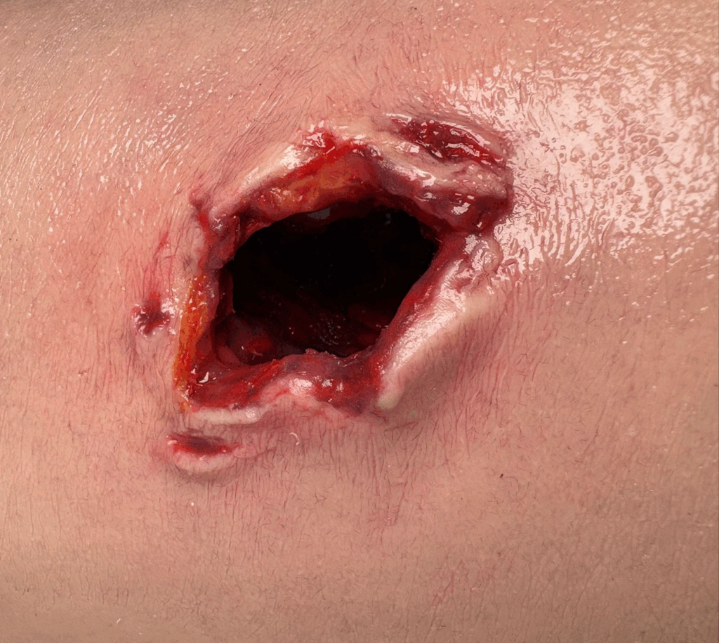 Close-up of wound packing practice on Tourn-IQ tourniquet trainer cavity