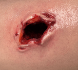 Close-up of wound packing practice on Tourn-IQ tourniquet trainer cavity